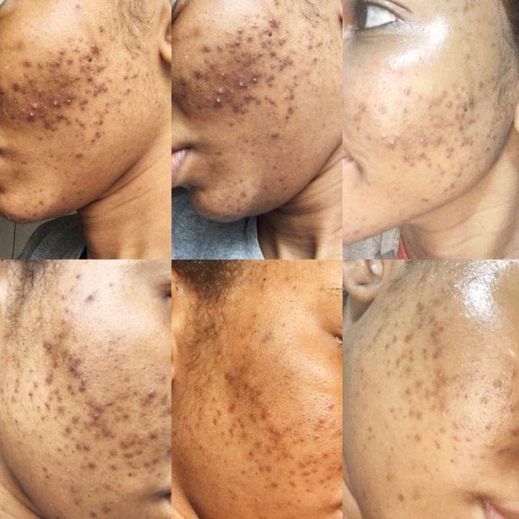 Before and after Korean skincare products in Nigeria